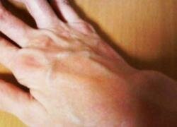 Лечение реактивного артрита.