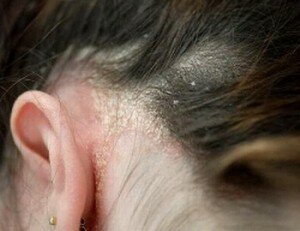 Как избавиться от перхоти и шелушения