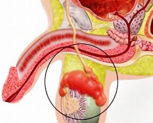 Орхит и эпидидимит.