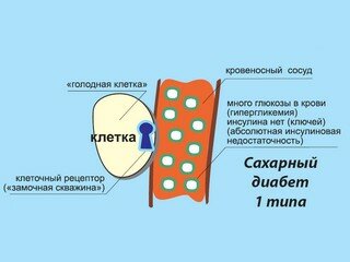 Сахарный диабет 1 типа.