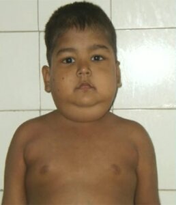 Синдром Иценко-Кушинга