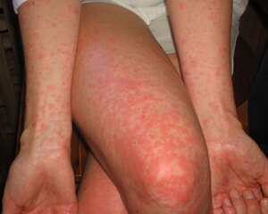 Лихорадка Денге (тропическая лихорадка)