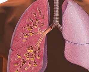 Муковисцидоз