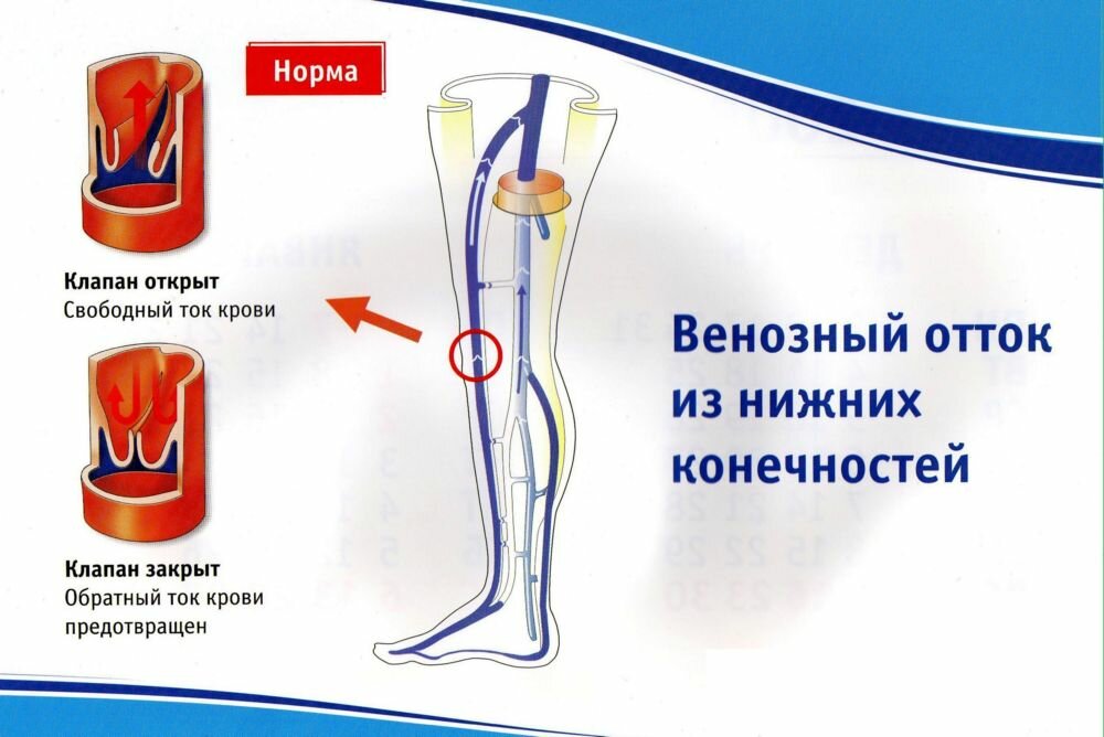 Работа венозных клапанов: общая информация, причины нарушения, симптомы, методы лечения